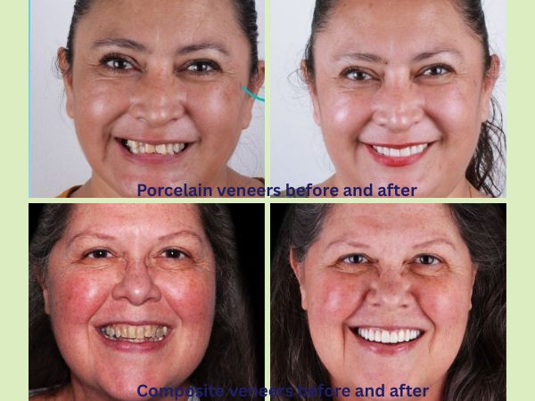 Porcelain veneers before and after and Composite Veneers before and after transformation images
