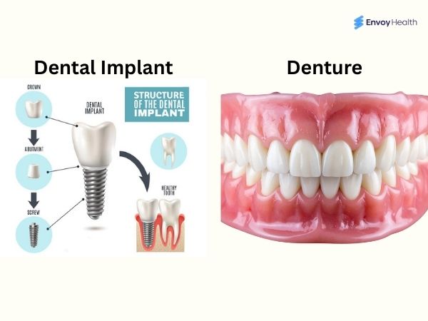 dental implants versus dentures