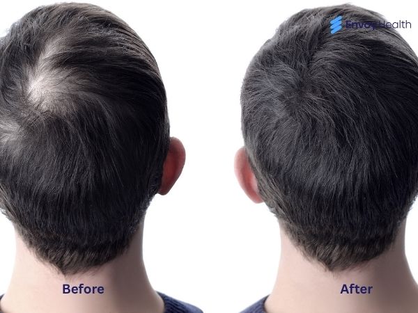 PRP before and after hair male images