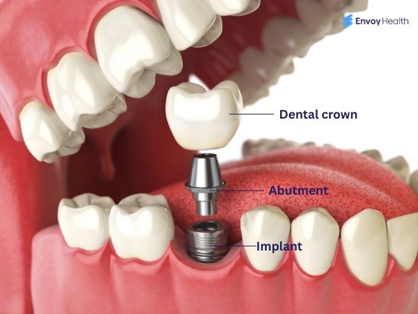 Implant parts in gum image