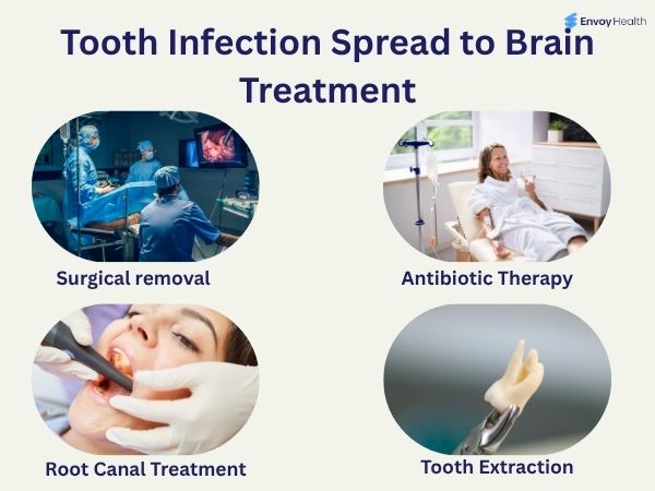 Tooth infection brain spread treatment