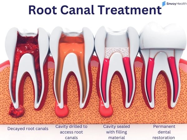 Root canal treatment steps with pictures 