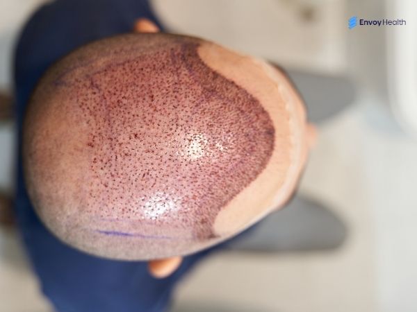 Good hair plugs that heal properly