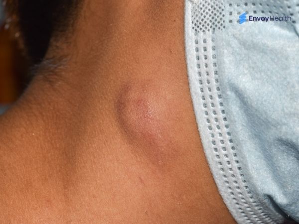 Swollen lymph nodes