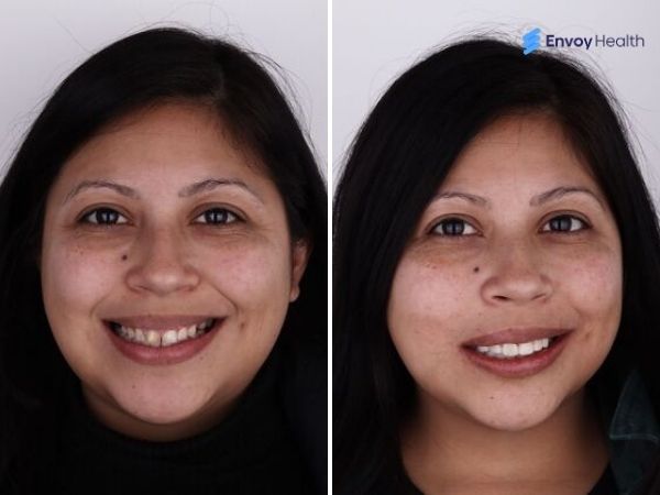 Veneers before and after women