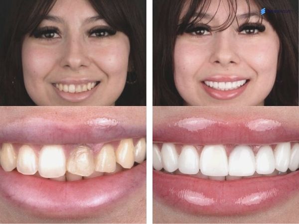 Caption: Veneers before and after women