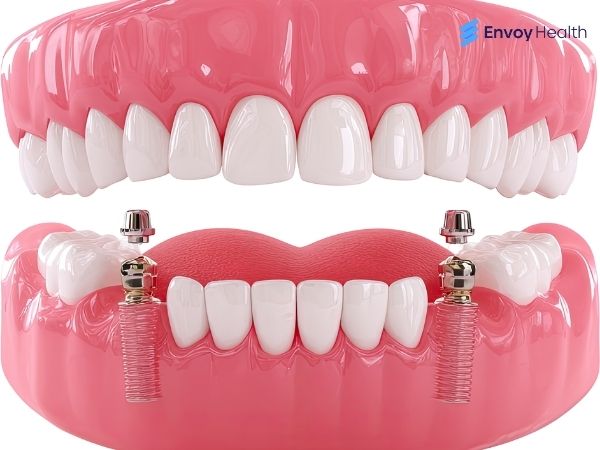 Implant supported dentures