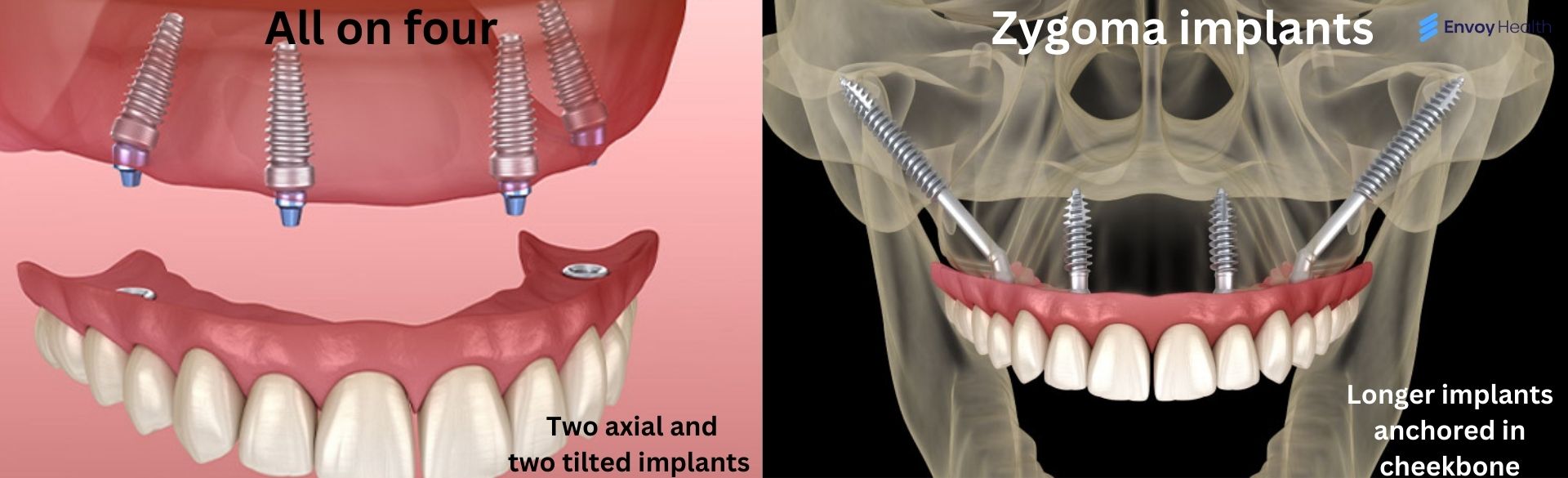 All on 4 versus zygomatic implants image