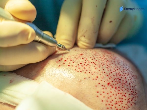 Hair transplant Surgical Technique