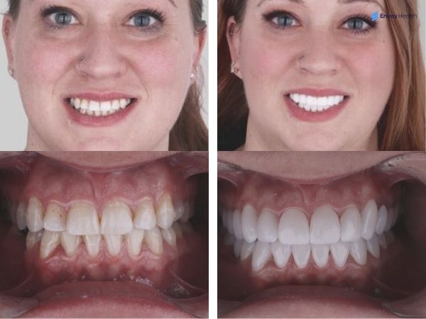 Veneers before and after women