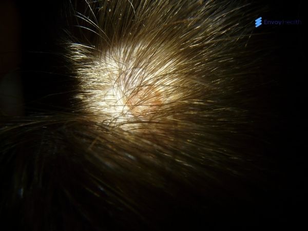 Scalp infection image