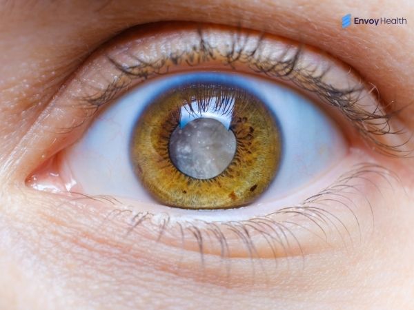 Cataract eye image