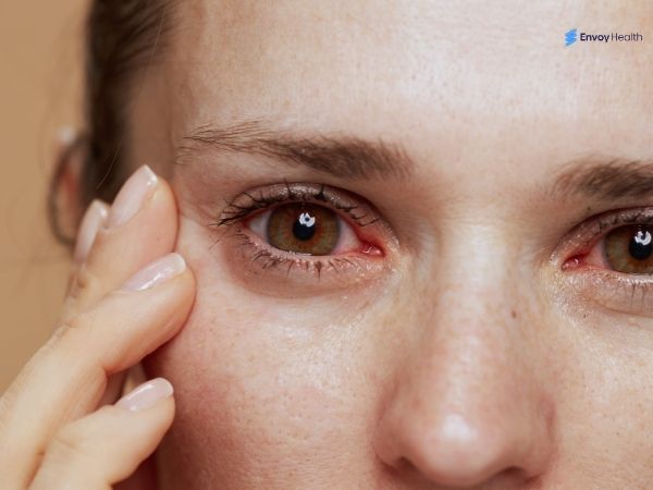Inflamed eyes