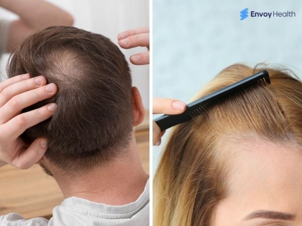 Male and female pattern baldness images