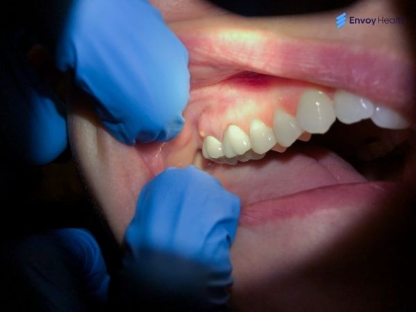 Tooth abscess Image