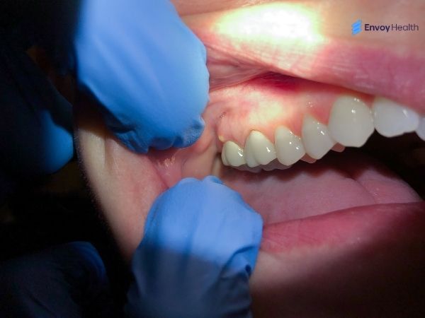 Dental abscess