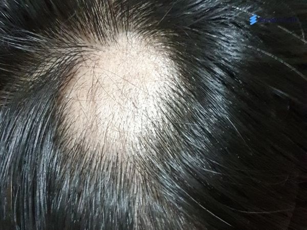 Scarring hair loss in patches