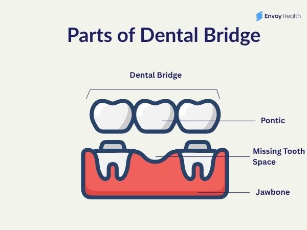 Parts of Dental Bridge