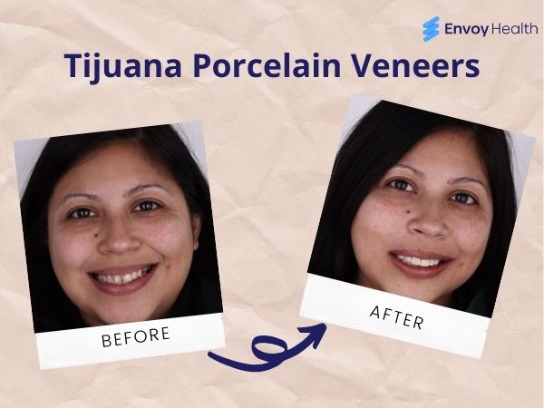 Before and after porcelain veneers in Tijuana