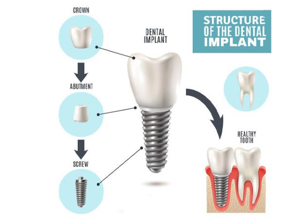 Dental implant parts