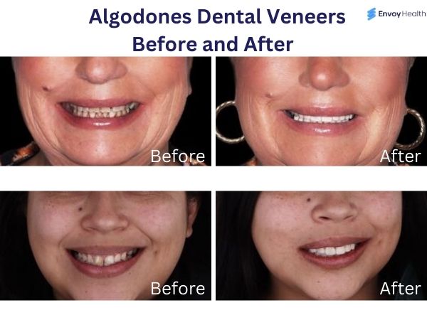 algodones veneers before after