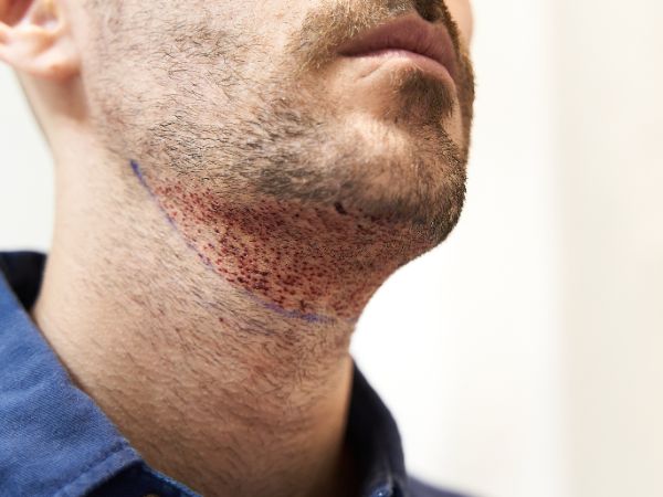 Beard Transplant Procedure 