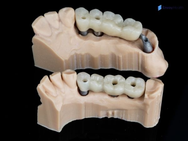 Dental Bridge Model 