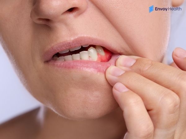 Localized gum problem 