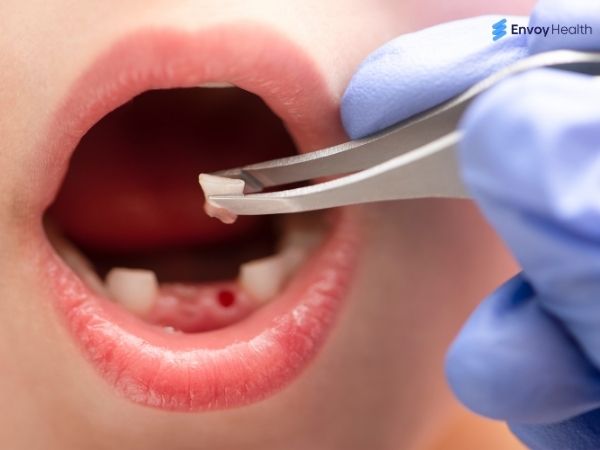 Tooth Extraction 