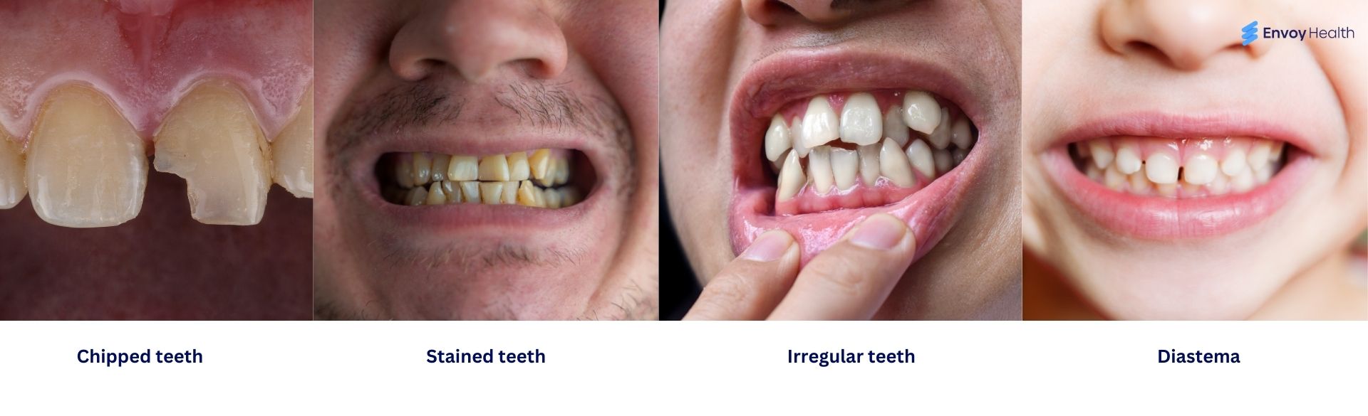 Problems That Dental Veneers Solve