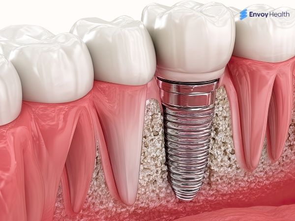 Endosteal implant image in gum 