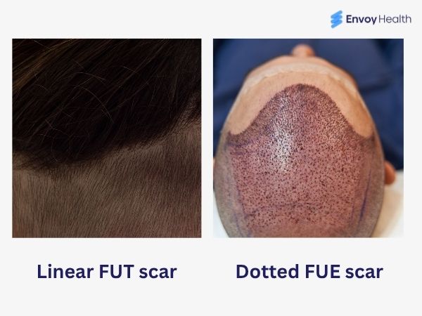 FUE versus FUT scar image 