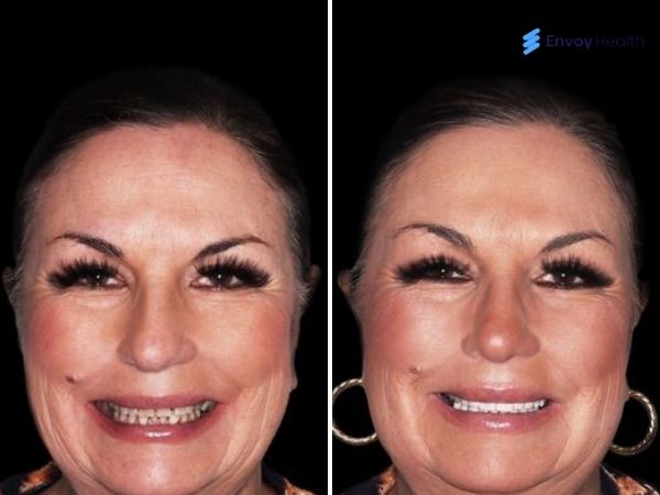 Caption: Veneers before and after women
