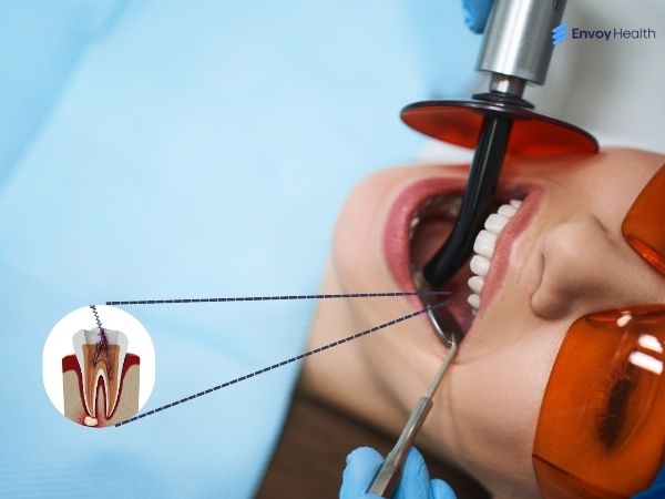 Root canal treatment