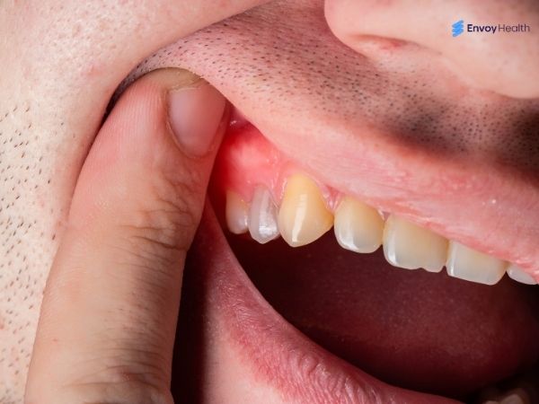 White lump on gums above teeth image