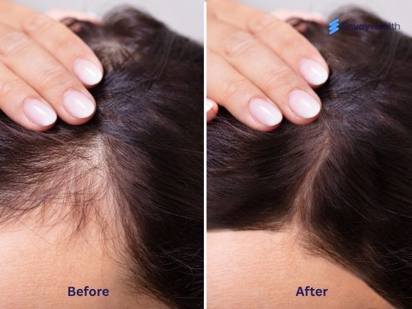 PRP before and after hair female images